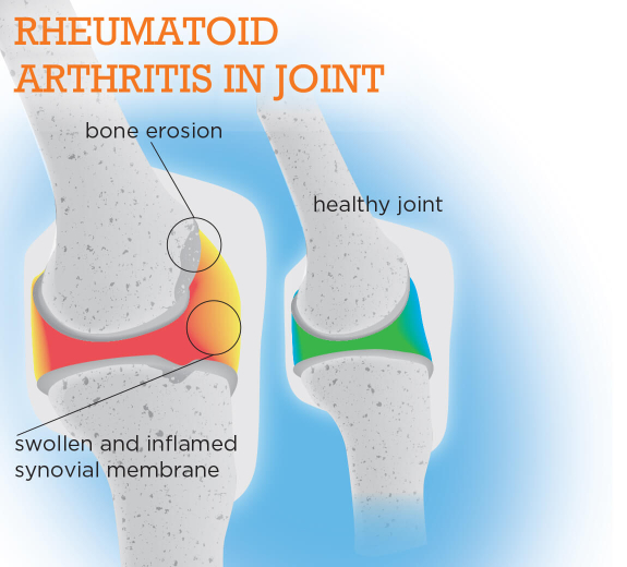 Featured 2D Rheumatoid Arthritis in Joint